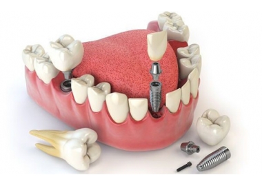 PHỤC HÌNH SỨ TRÊN IMPLANT